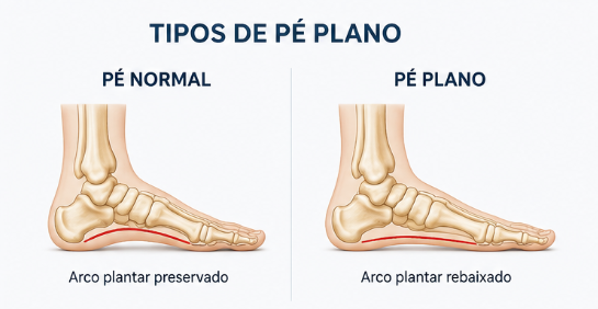 Ilustração: O que é pé plano?