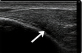 Fascite Plantar: causas, sintomas e tratamento