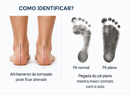 Ilustração: Quais são as causas do pé plano?