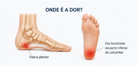 Ilustração: O que é fascite plantar?